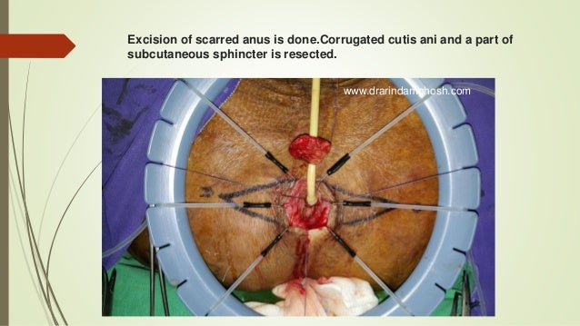 anal spinchter reconstruction Anal spinchter reconstruction